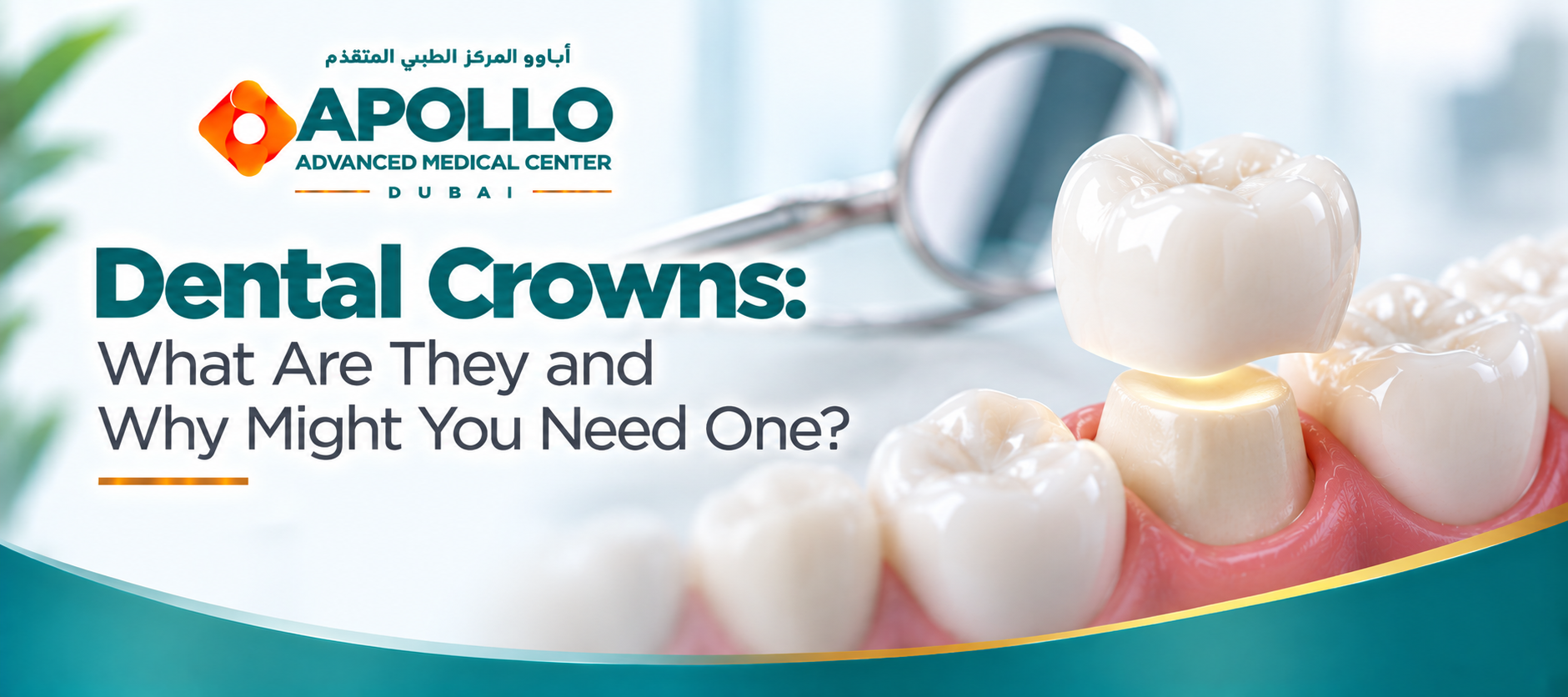 Dental Crowns: What Are They and Why Might You Need One?
